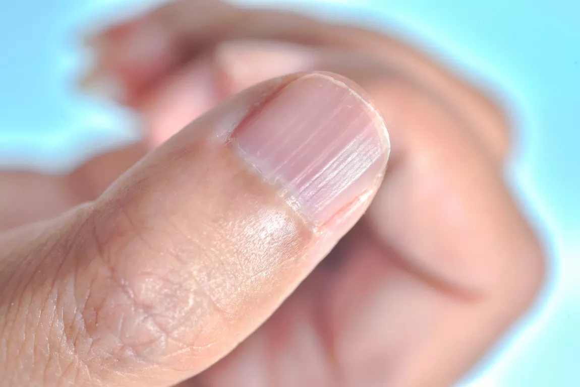 Santé : ces stries sur vos ongles qui en disent long sur votre corps